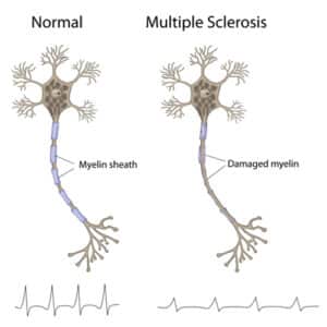 Multiple Sclerosis Best Neurologist in jalandhar Punjab India