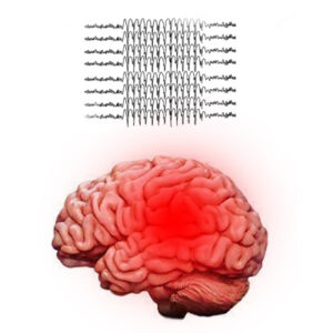 Generalized-Seizures--Epilepsy-Attack,-A-Guide-by-Dr.-Sandeep-Goel,-Best-Neurologist-in-Jalandhar,Punjab,India