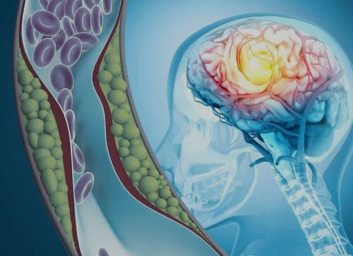 brainstrokeNHS-neurocare-Dr-Sandeep-Goel-Best-Neurologist-in-Jalandhar,Punjab,India