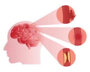 Brain stroke-Best-Neurologist-in-jalandhar-India-Punjab
